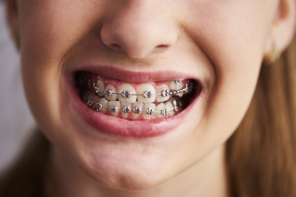 Teeth Braces Prices In India And Its Benefits